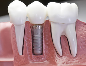 Dental implants  - Leduc dentist