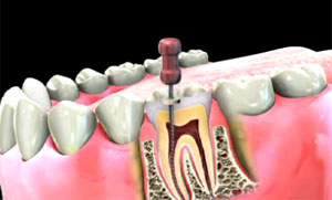 root canal  - Leduc dentist