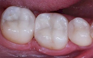 White Fillings  - Leduc dentist