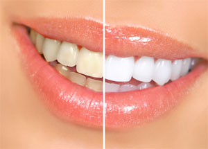 whitening - Leduc dentist